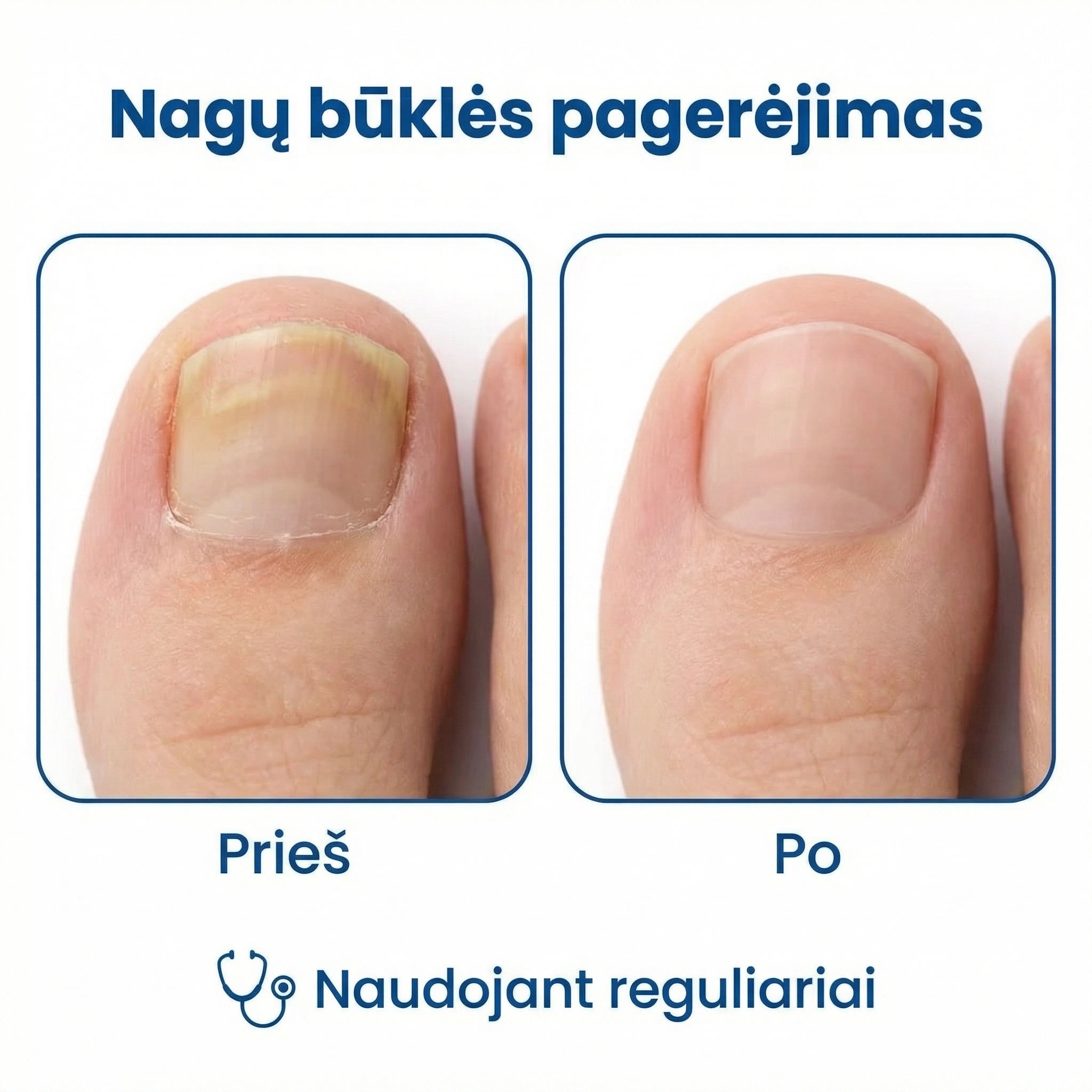 NAGUREX – Naktinis hidrogelio pleistras nuo nagų grybelio